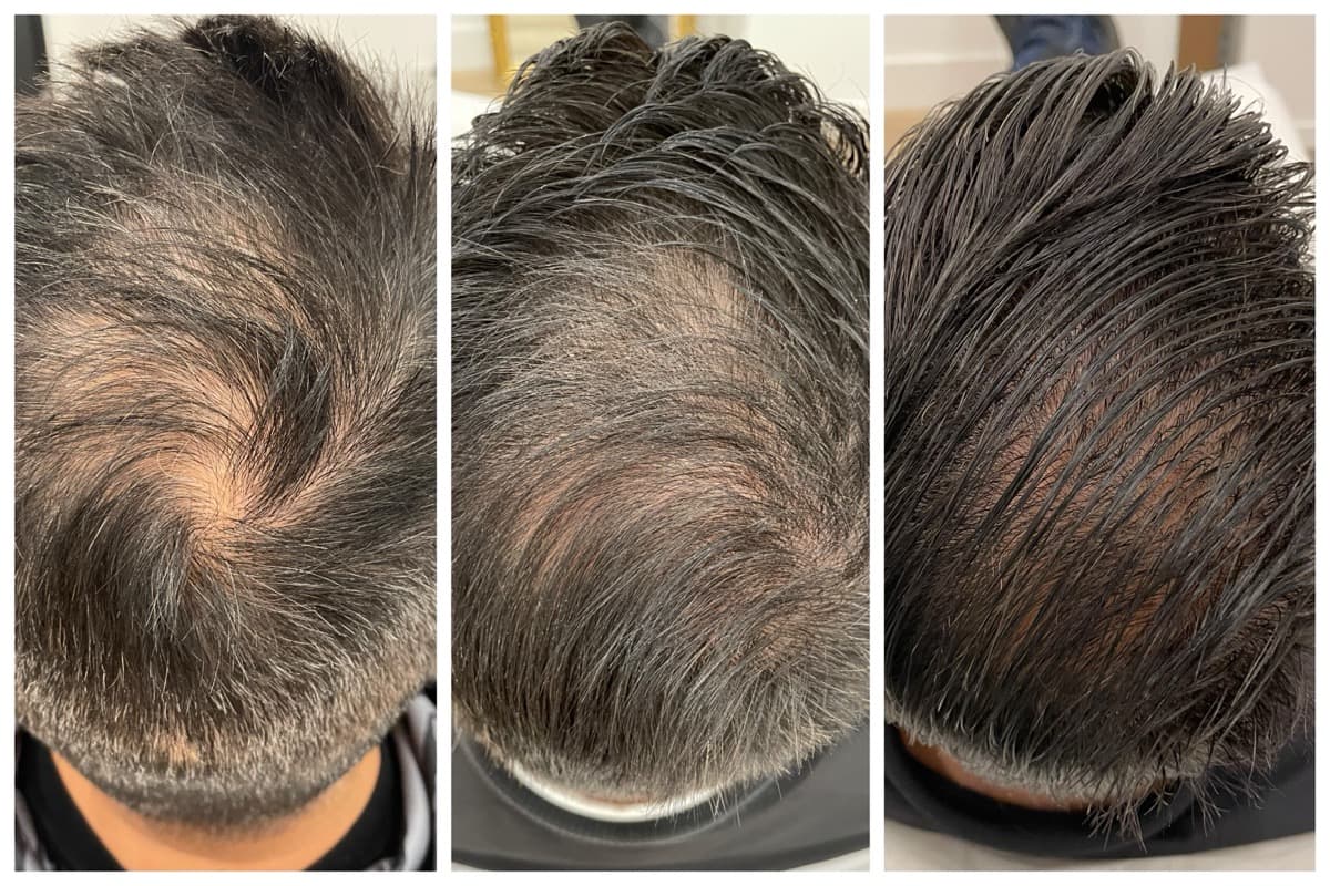 KeraLase scalp before and after, baseline through three and six treatments, courtesy Rumur