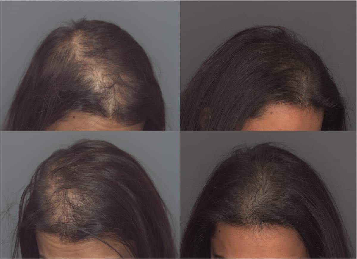 KeraLase scalp before and after, four treatments, courtesy Ziering Medical