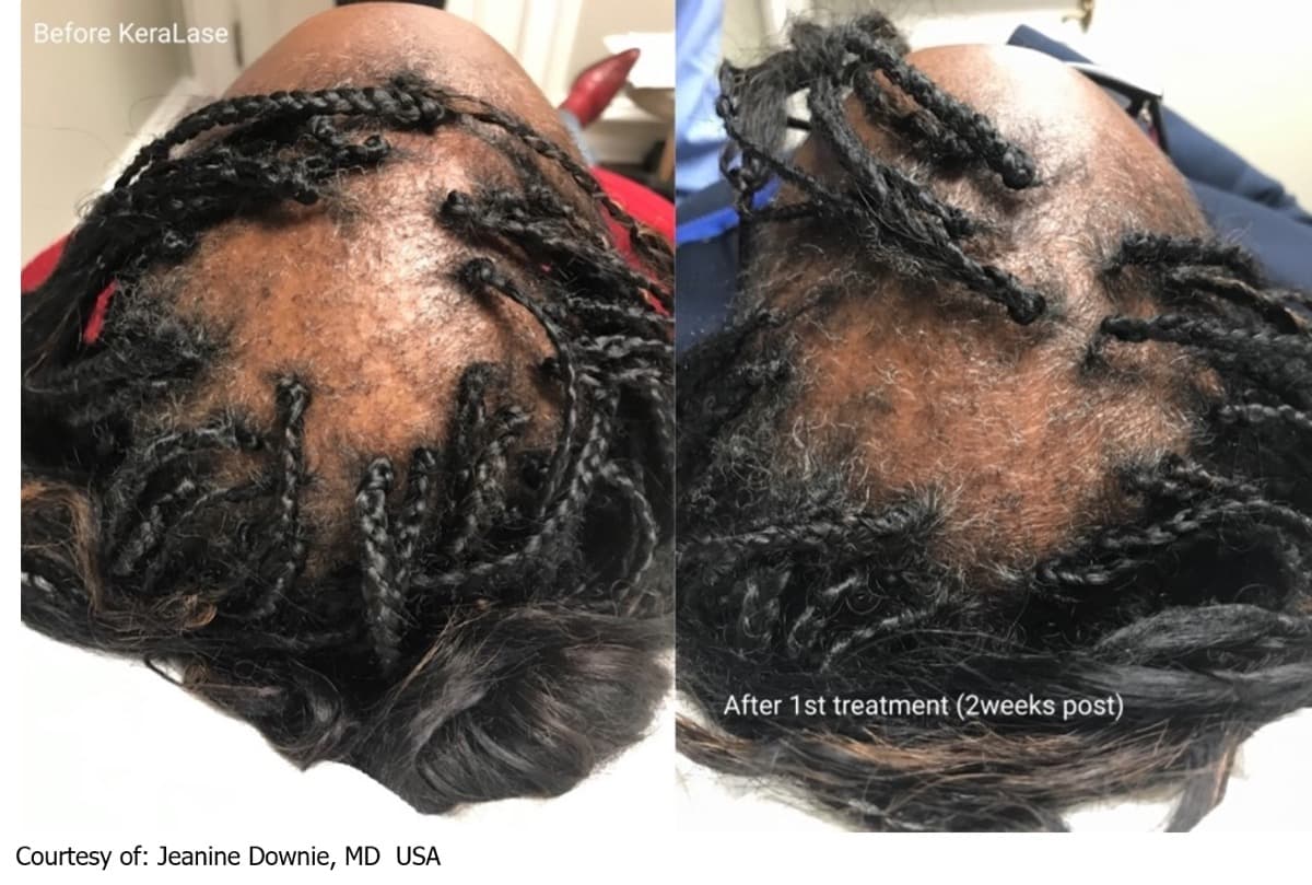KeraLase scalp treatment outcome, courtesy Dr. Jeanine Downie
