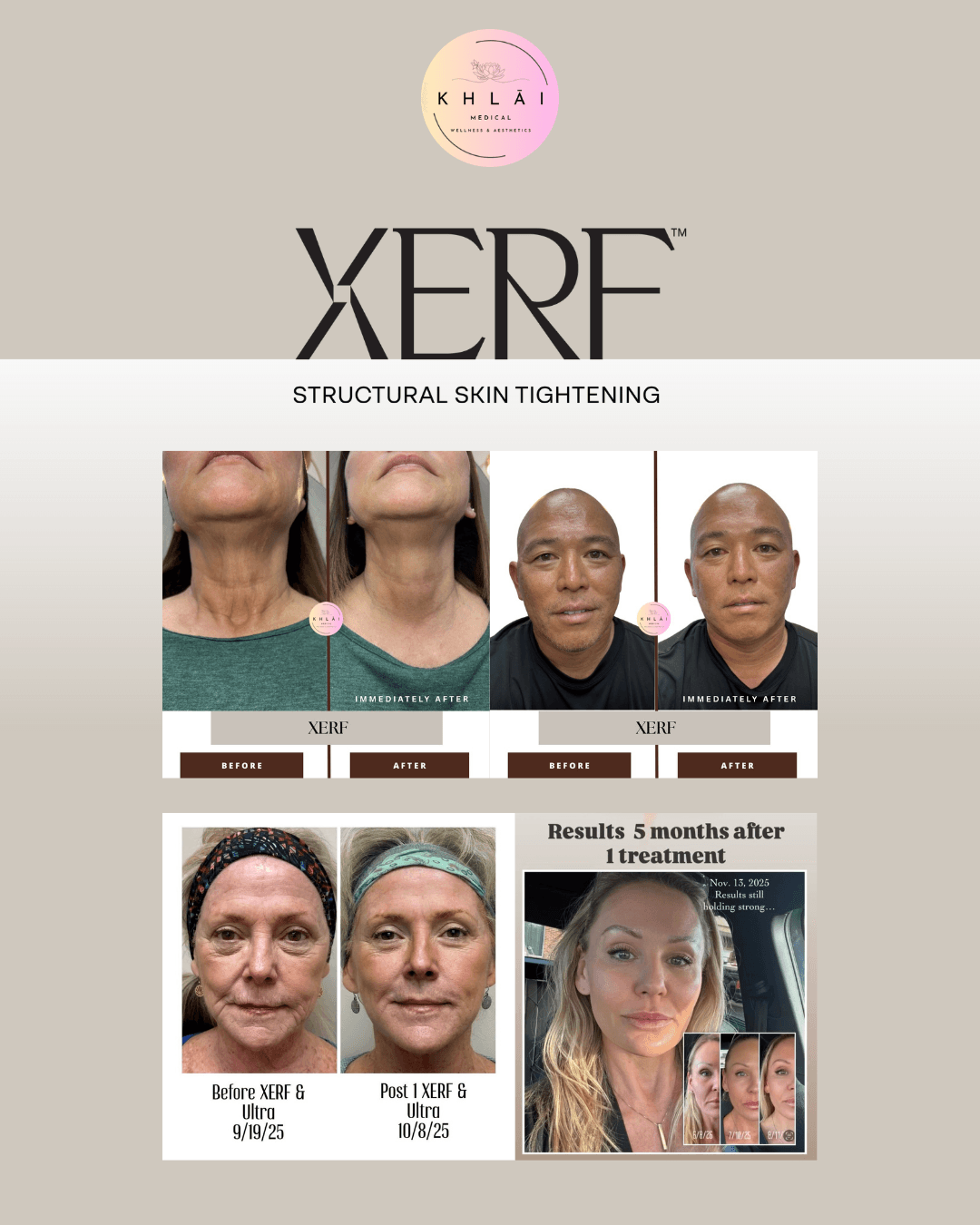 Before and after XERF treatment, four client examples showing jawline and neck tightening